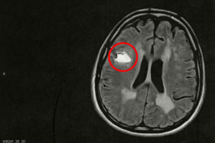 A white spot on this MRI scan, enclosed in the red circle, indicates that this patient is a stroke victim. Senior Annalee Gabler worked with MRI and CT scans of stroke victims in her internship at the Neurology Ward of St. Agnes Hospital for her Senior Project. 